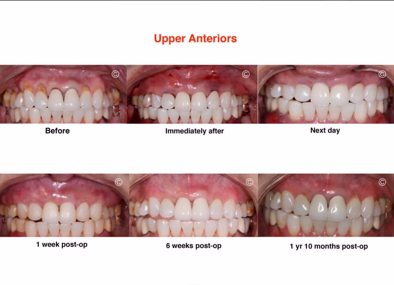upper anteriors
