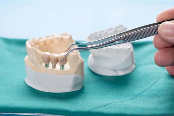 How a Prosthodontist Plans Dental Implants Differently for Lynnwood Patients